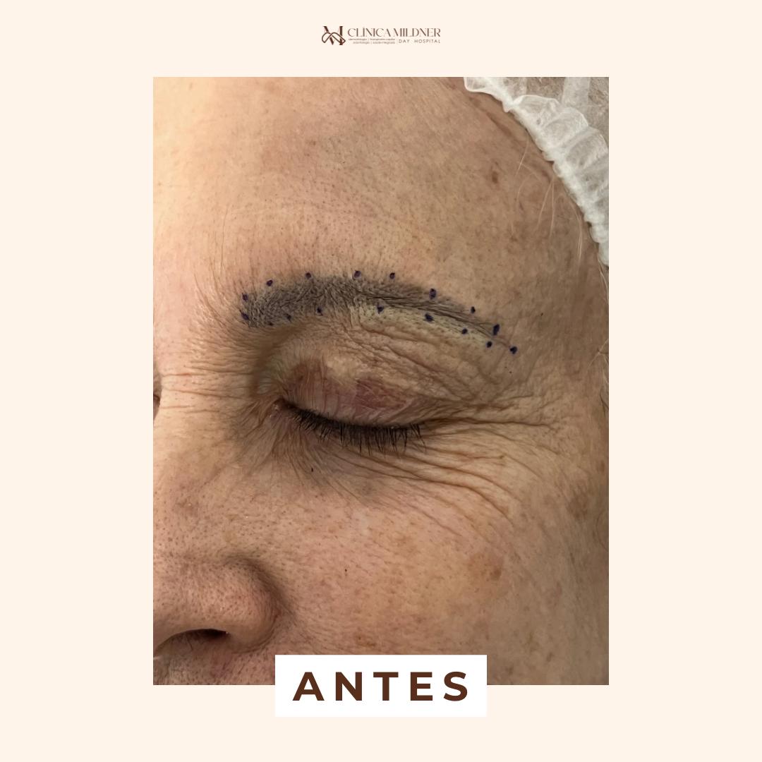 antes