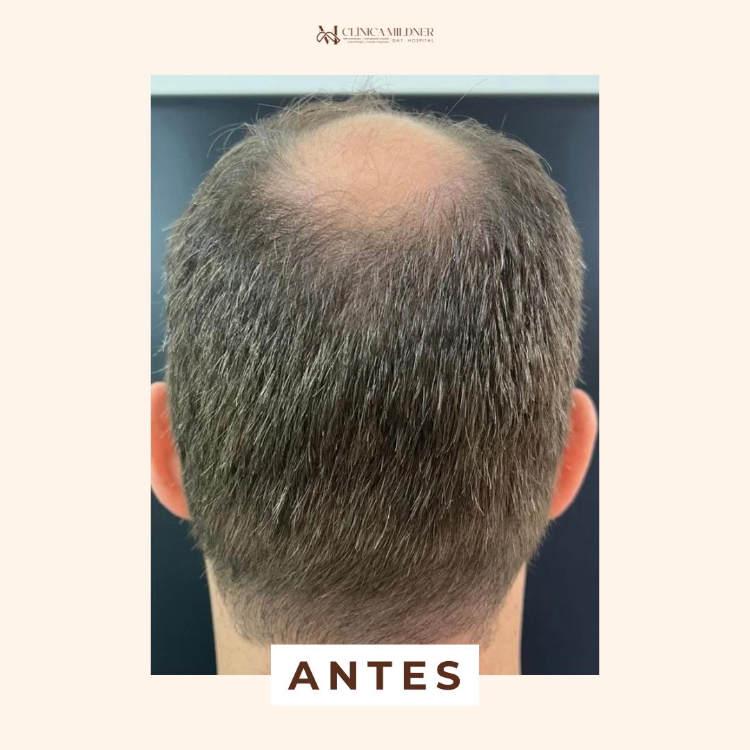 antes